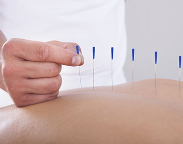 acupuncture